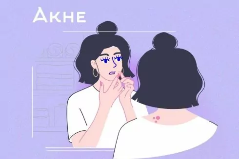 Как избавиться от акне на лице: советы косметолога