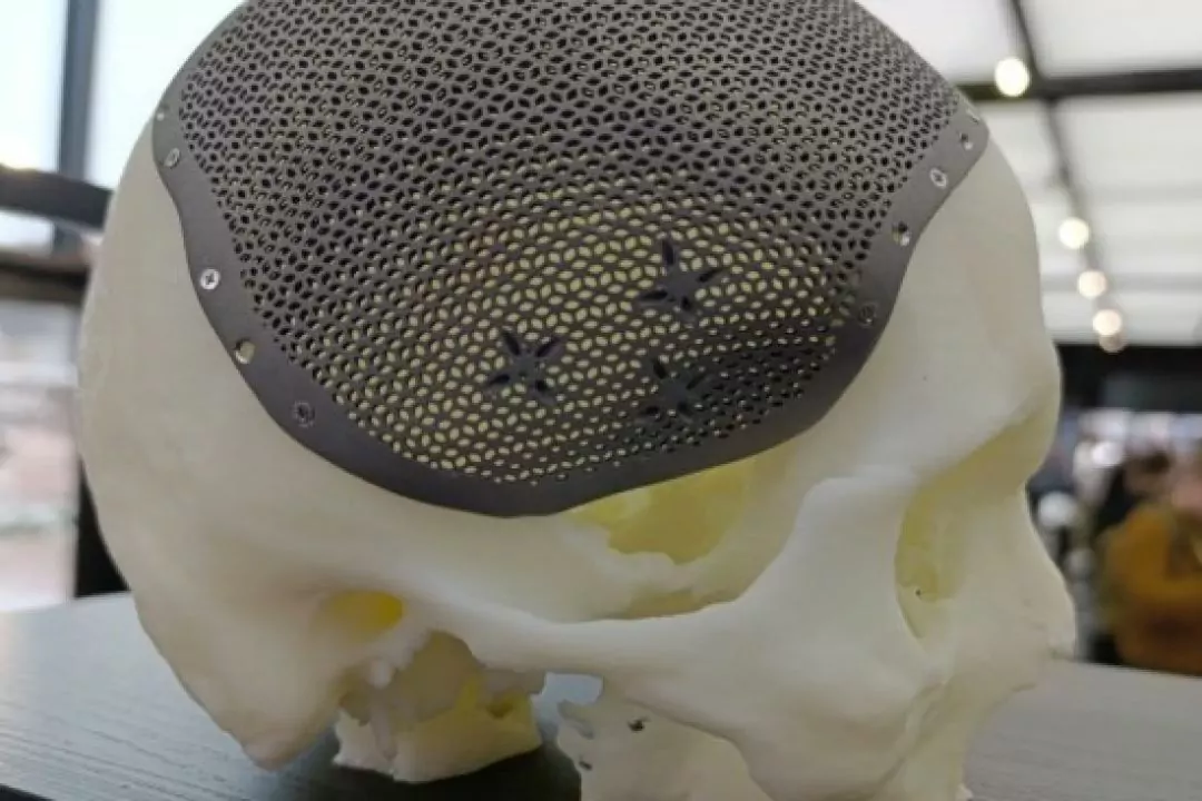 У Києві друкують на 3D-принтері титанові імпланти для постраждалих на війні