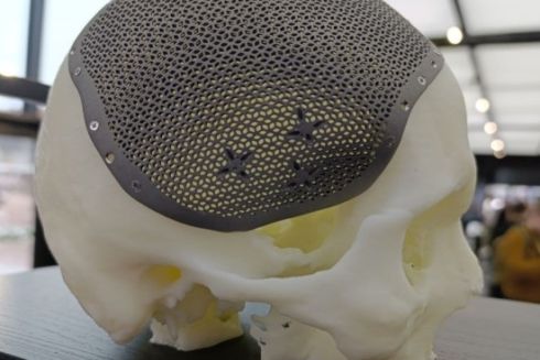 У Києві друкують на 3D-принтері титанові імпланти для постраждалих на війні