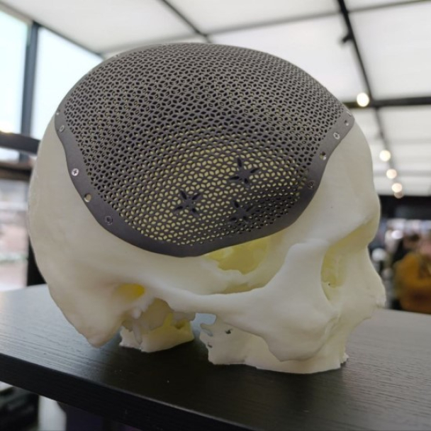 У Києві друкують на 3D-принтері титанові імпланти для постраждалих на війні